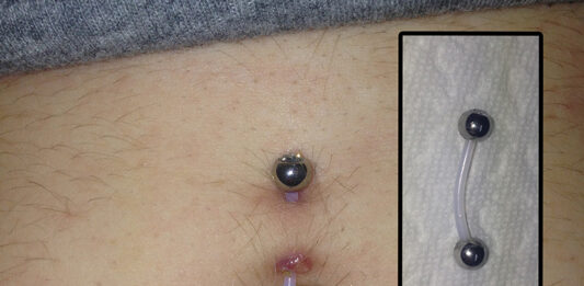 PTFE Bauchnabelpiercing